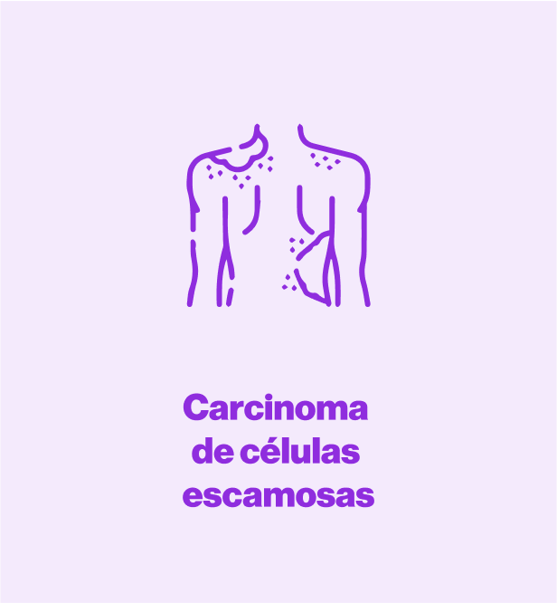 Carcinoma de células escamosas