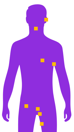 ¿Dónde se puede  localizar la HS?